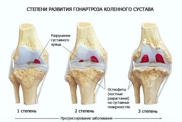 Артроз дугоотросчатых крестцово удлиненных суставов. Что такое артроз: виды и степени артроза суставов - АКАДЕМФАРМ Крестцово-подвздошный сустав: боль и артроз, лечение Артроз суставов (остеоартроз): причины, симптомы и лечение - travmasport
